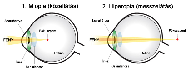 a látás receptorok hyperopia kezd kialakulni